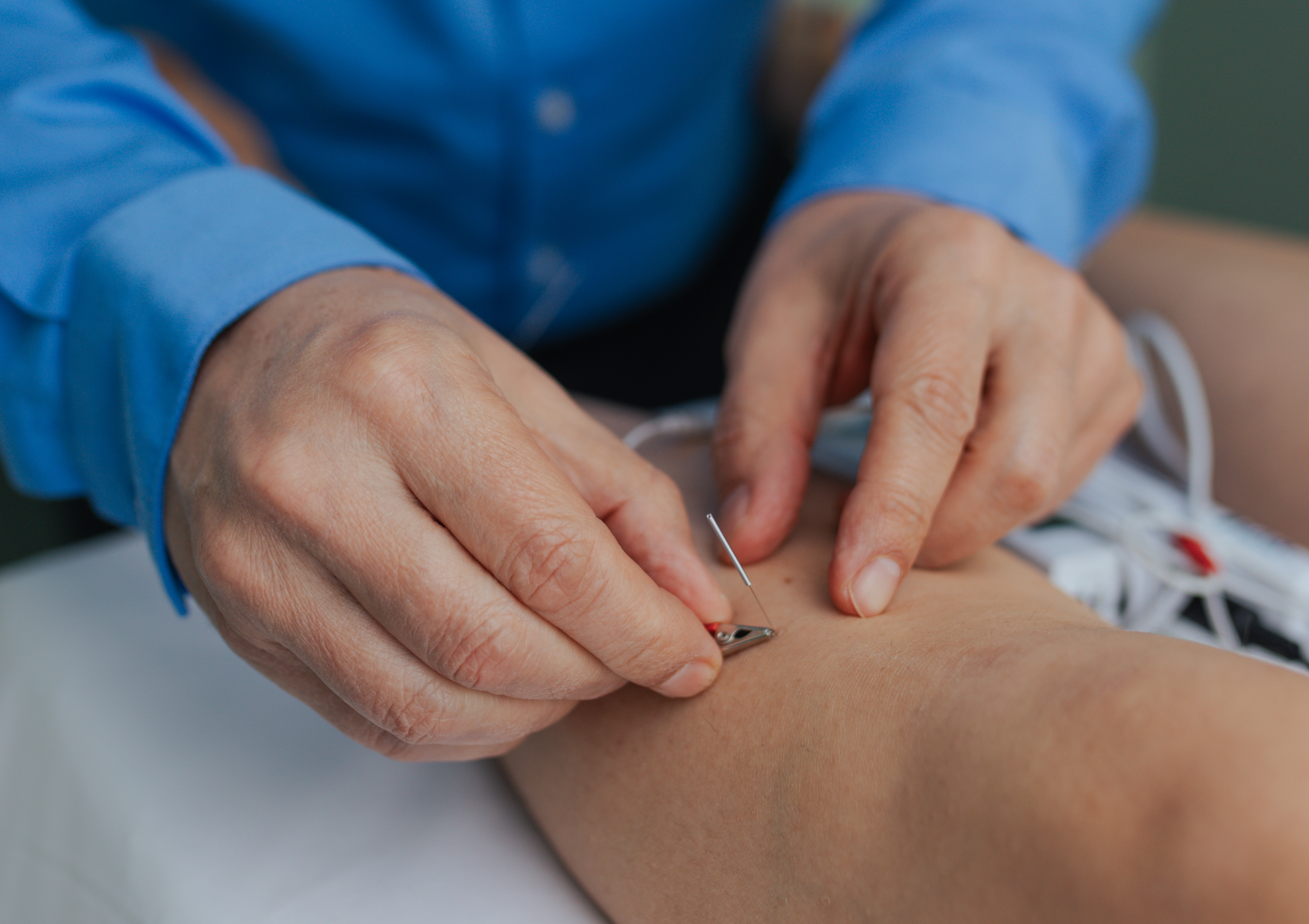 acupuncture needles