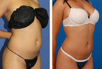body-contouring-results1