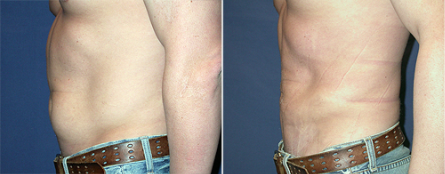 body-contouring-results2